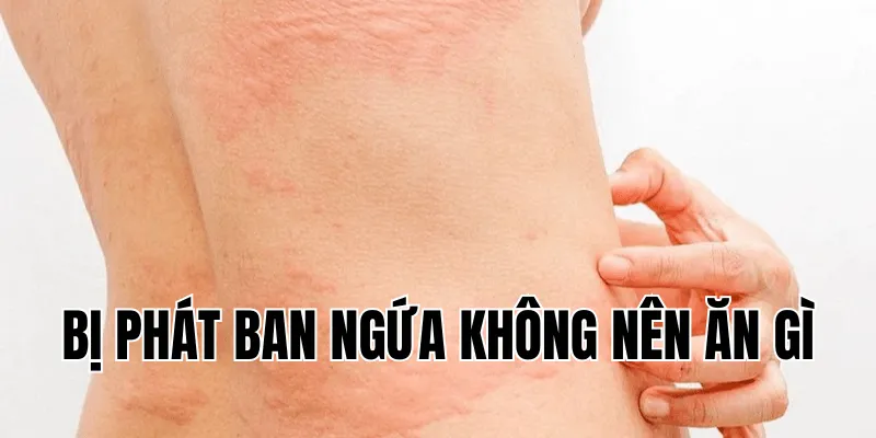 bị phát ban ngứa không nên ăn gì
