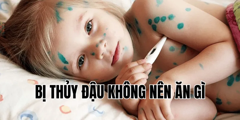 bị thủy đậu không nên ăn gì