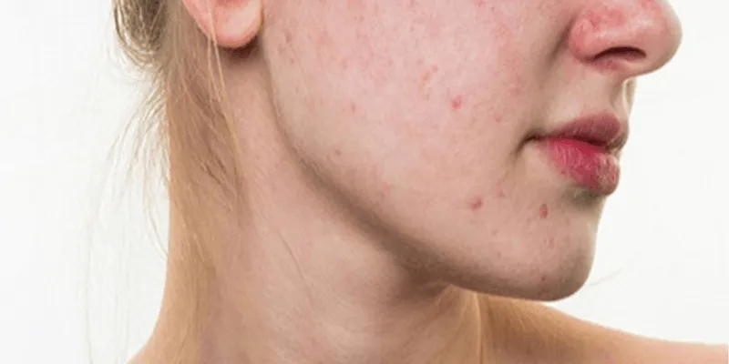 Hiểu đúng về nóng gan nổi mụn