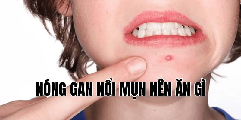 nóng gan nổi mụn nên ăn gì